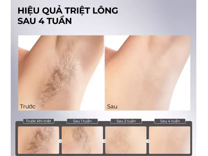 Máy triệt lông lạnh Sapphire Halio InfinityGlow Advanced IPL Cooling Hair Removal Device