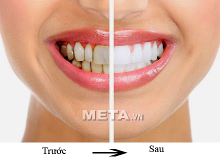 Đèn làm trắng răng Lanaform Whitening Flash sẽ mang lại hiệu quả làm trắng thật bất ngờ.