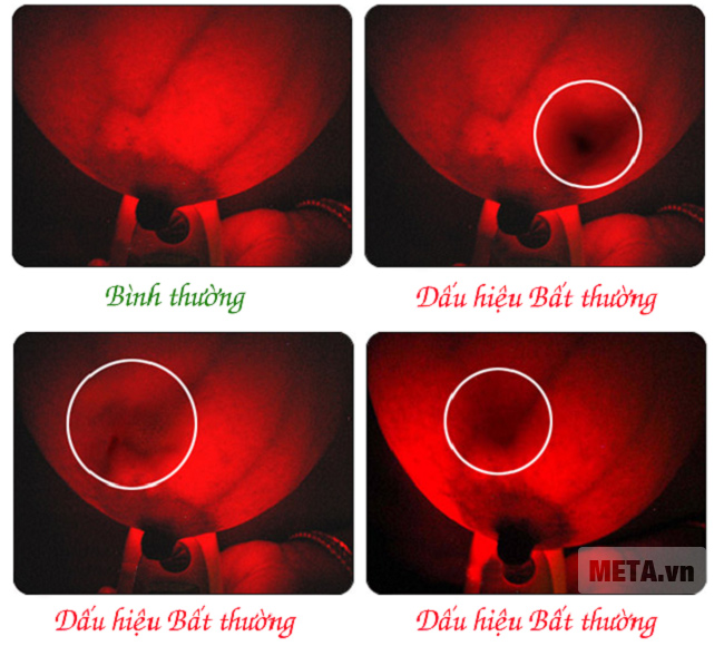 Hình ảnh minh họa khi sử dụng của thiết bị phát hiện ung thư vú Breastlight.