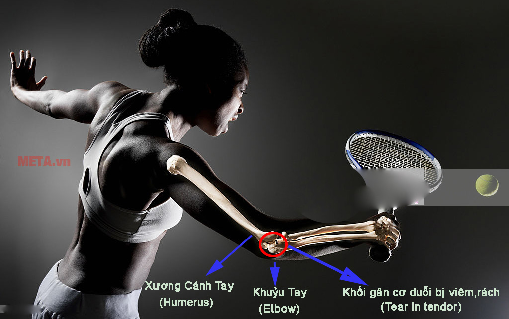 Đai nẹp khuỷu tay 