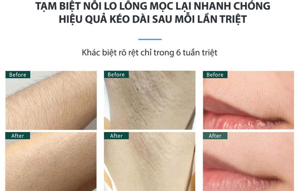 Máy triệt lông dùng pin